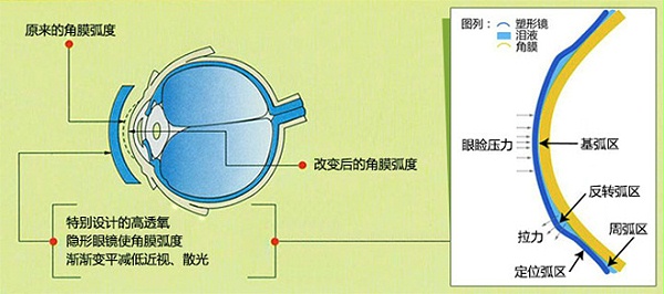 角膜塑形镜的作用原理