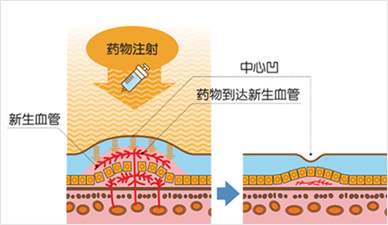 抗新生血管治疗