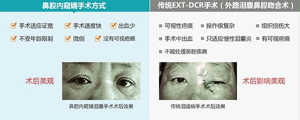 泪道手术方式对比