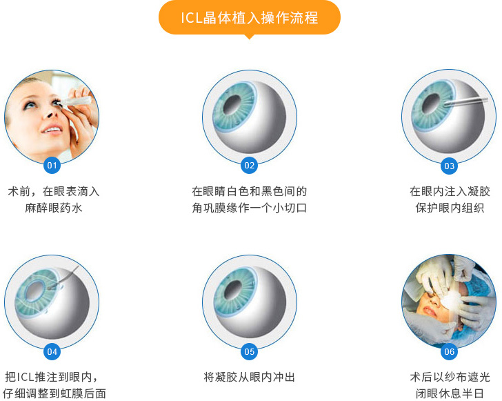 ICL晶体植入操作流程