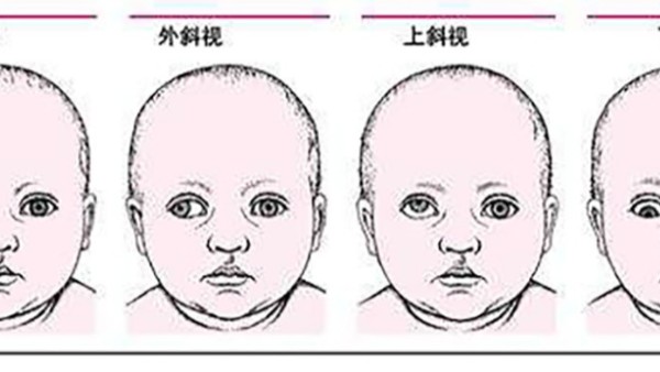 如何预防儿童斜视