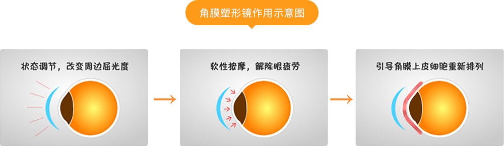 角膜塑形镜作用示意图