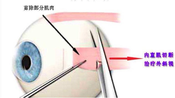 衡水斜视应该怎么矫正