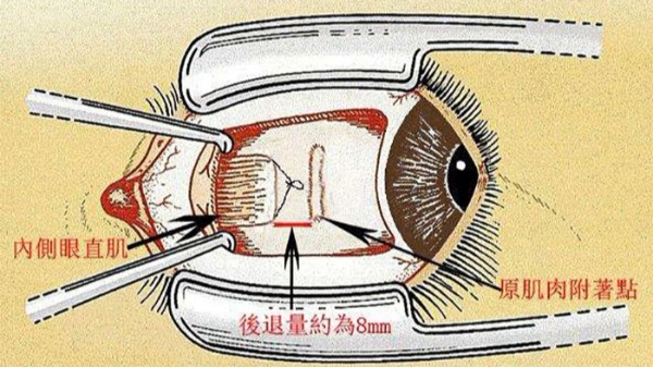 衡水斜视手术后注意事项都要注意什么