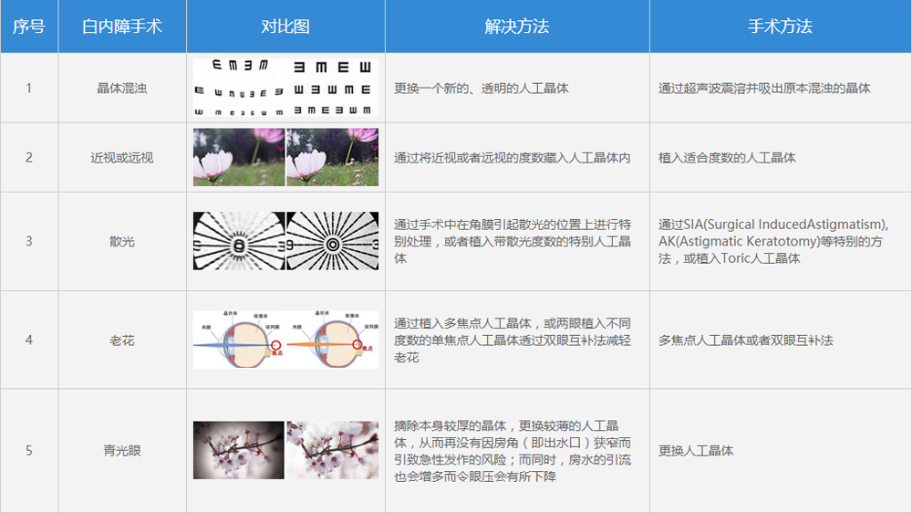 白内障超声乳化联合人工晶体植入手术