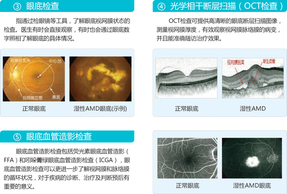 湿性老年黄斑变性专科检查