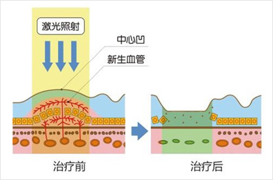 激光光凝术