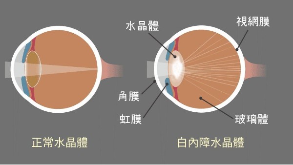 轻微白内障不是小事 及时治疗是正道