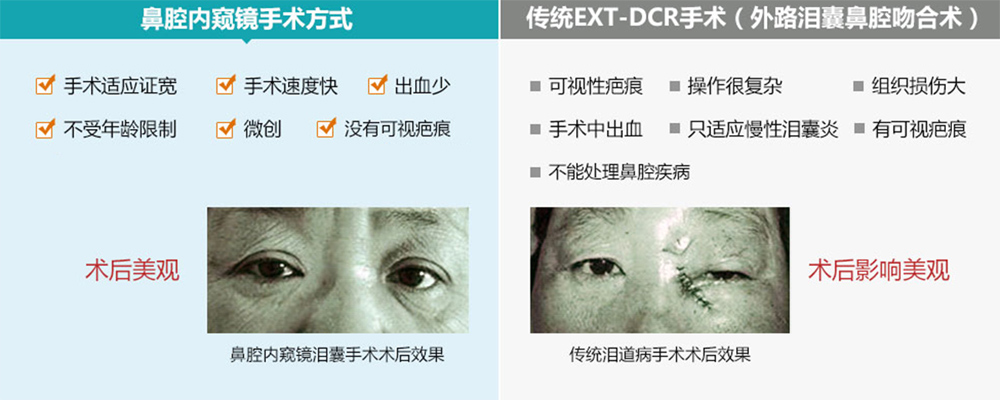 泪道手术方式对比