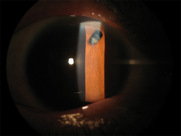 高度近视先天性瞳孔上移合并白内障过熟期及晶体半脱位病历分析1例