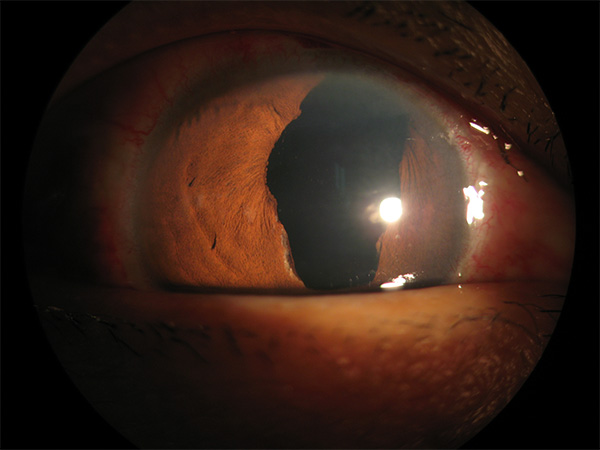 高度近视先天性瞳孔上移合并白内障过熟期及晶体半脱位病历分析1例